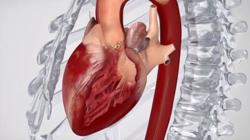 Come by with Singapore Heart Valve Repair Features